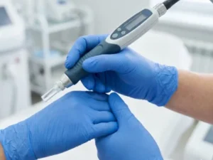 درمان زگیل تناسلی با لیزر